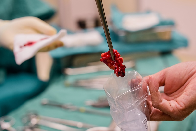 Surgical Oncology Image